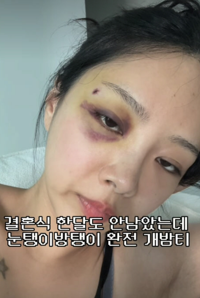 “결혼식 한 달도 안 남았는데…” 10기 옥순 김슬기, 눈가 피멍에 걱정 쏟아진 이유