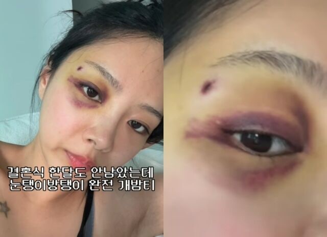 나솔 10기 옥순, 결혼식 한 달 앞두고 눈에 '개밤티'…남편 유현철의 반응은? "여보 고마워"