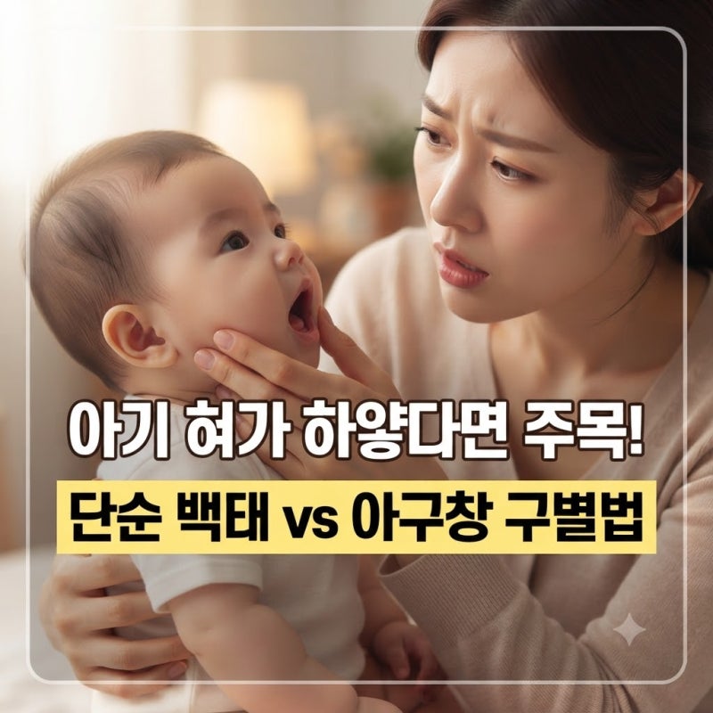 아기 혀가 하얗다면 주목! 단순 백태와 무서운 '아구창' 구별하는 결정적 차이