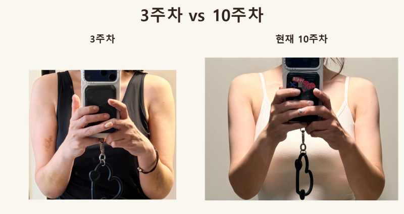 40대 후반 팔뚝 지방추출주사 10주차!! 팔뚝살 변화 직접 비교해봤습니다