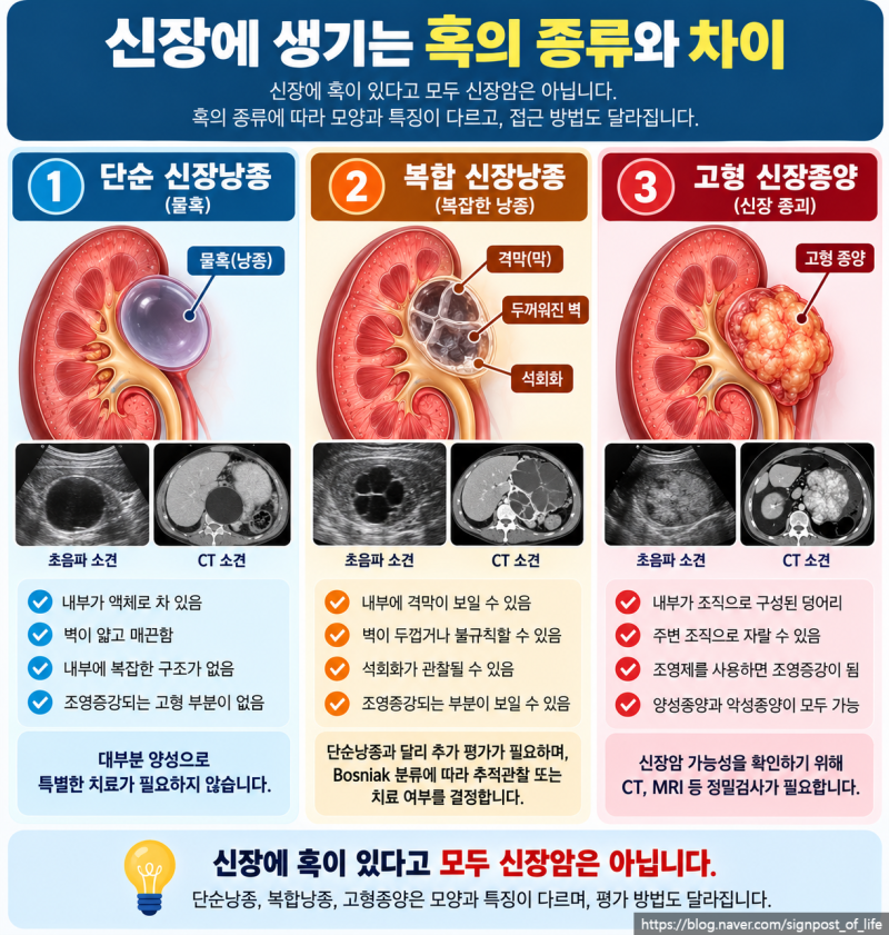 신장에 혹이 발견됐다면? 신장 물혹과 신장암 차이