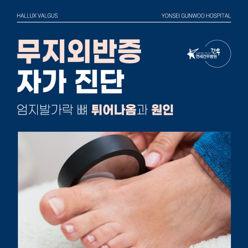 신림정형외과 무지외반증 자가 진단, 엄지발가락 뼈 튀어나옴과 휨 변형 원인