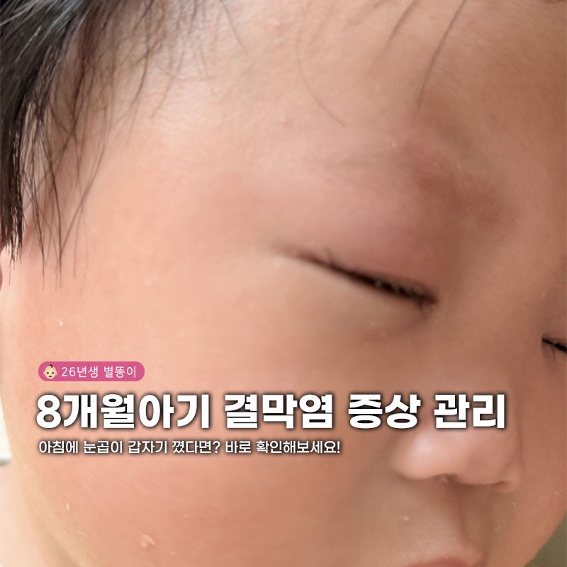 "아침에 눈곱이 갑자기?" 8개월 아기 결막염 증상부터 전염 관리까지