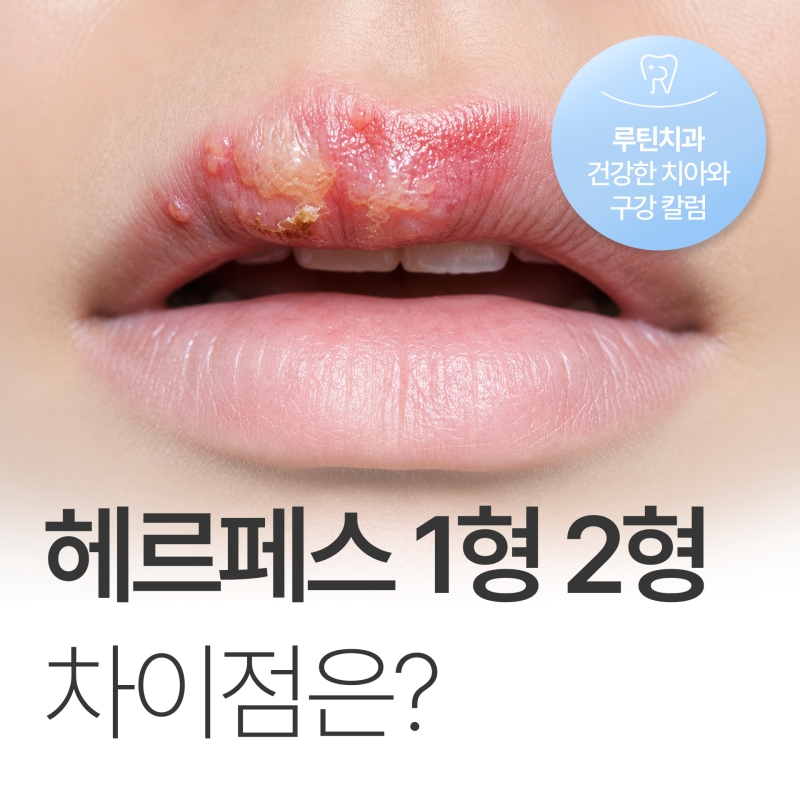 입술 헤르페스 1형 2형 원인과 증상, 감염경로 다른가요?