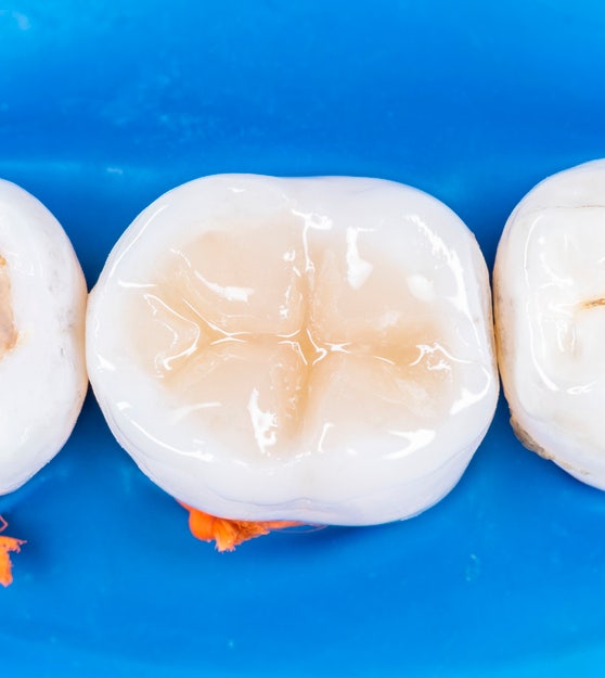 치과 크라운 치료 비용, 재료별 가격은 얼마인가요?