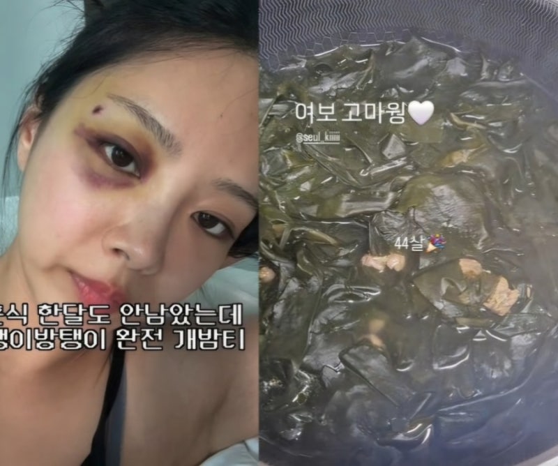 결혼식 한 달도 안 남았는데 김슬기 눈이 ‘밤탱이’ 됐다 이게 진짜 밤티 아닐까