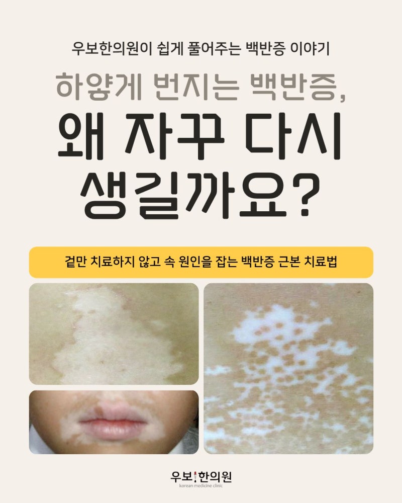 하얗게 번지는 백반증, 왜 자꾸 다시 생길까?