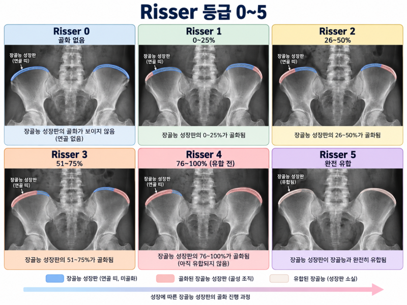 청소년 척추측만증이 위험한 이유 , 골성숙도 Risser 등급