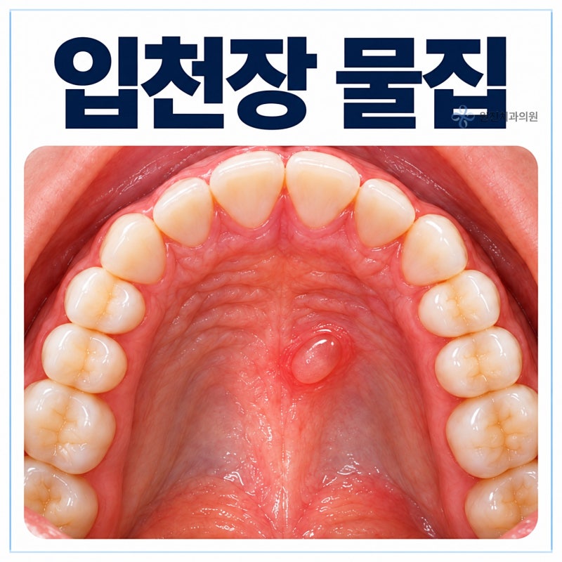 입천장 물집 터뜨려도 될까? 원인과 치과에 가야 할 때는?