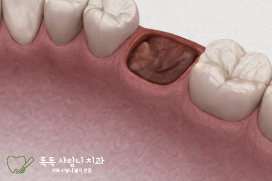 대구 수성구 사랑니 치과, 발치 당일 운동해도 될까요?