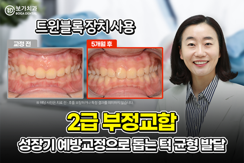 2급부정교합 FAQ｜2급부정교합은 어떤 상태이며 치아교정이 필요한가요?