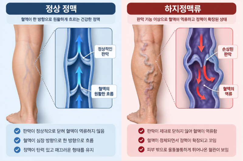 하지 정맥류 실손보험 청구, 입원했는데 통원 처리되는 이유!! 안내해드릴게요.