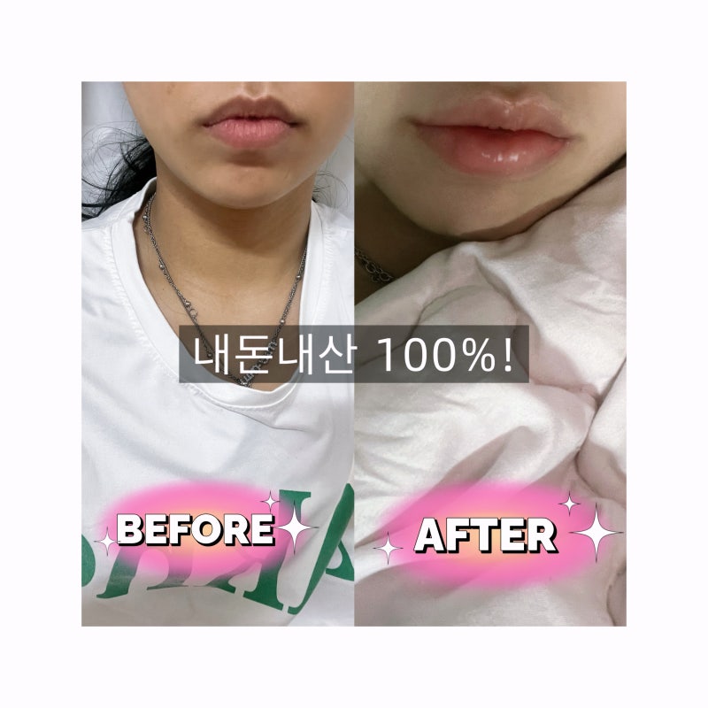[내돈내산]대구 입술필러 1주일차 경과｜ 부작용 없으려면 이 3가지는 절대 피하세요! (붓기·....