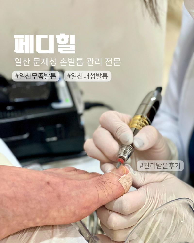 일산 발톱무좀 관리 페디힐, 몇십년 묵은 일산 내성발톱 교정 후기