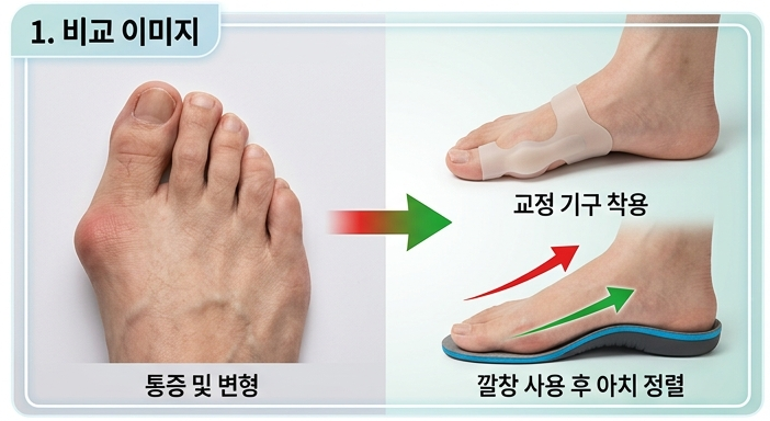 무지외반증 극복 운동과 깔창 소개 : 엄지발가락 통증 줄이는 핵심 요약