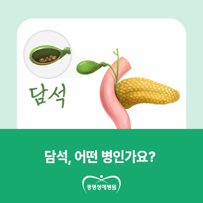 체한 줄 알았는데 담석? 오른쪽 윗배 통증 주의