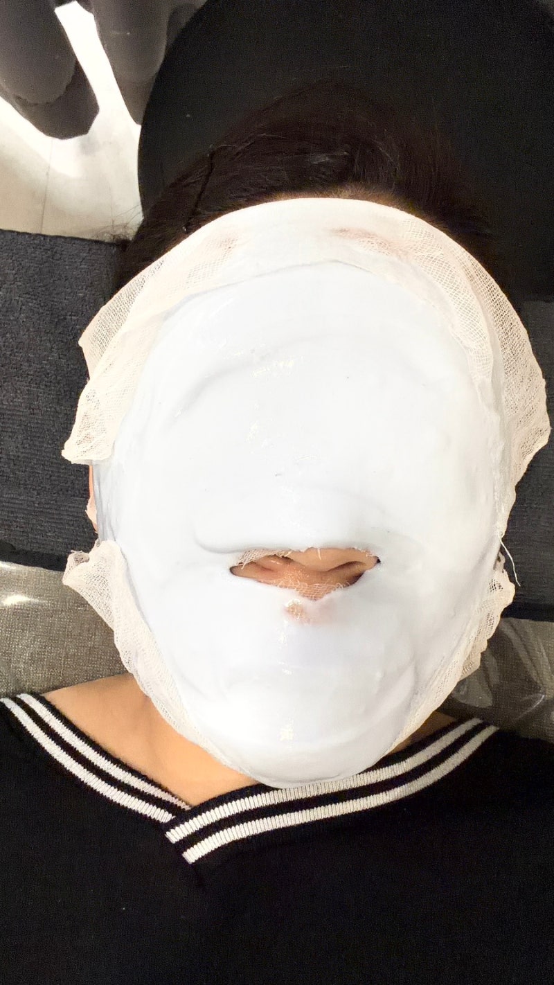 화농성 여드름 모낭염 피부 피부과 시술 후기 : 아쿠아필 + 압출 + 염증주사 + 크라이오 + 모델....