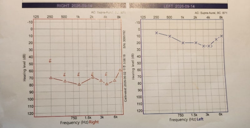 돌발성난청 치료 후기 (2026년 9월)