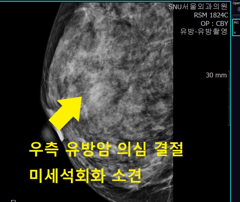 유방 미세석회화 조직검사, 유방초음파 없이 입체정위유방생검술로만 가능할까요?