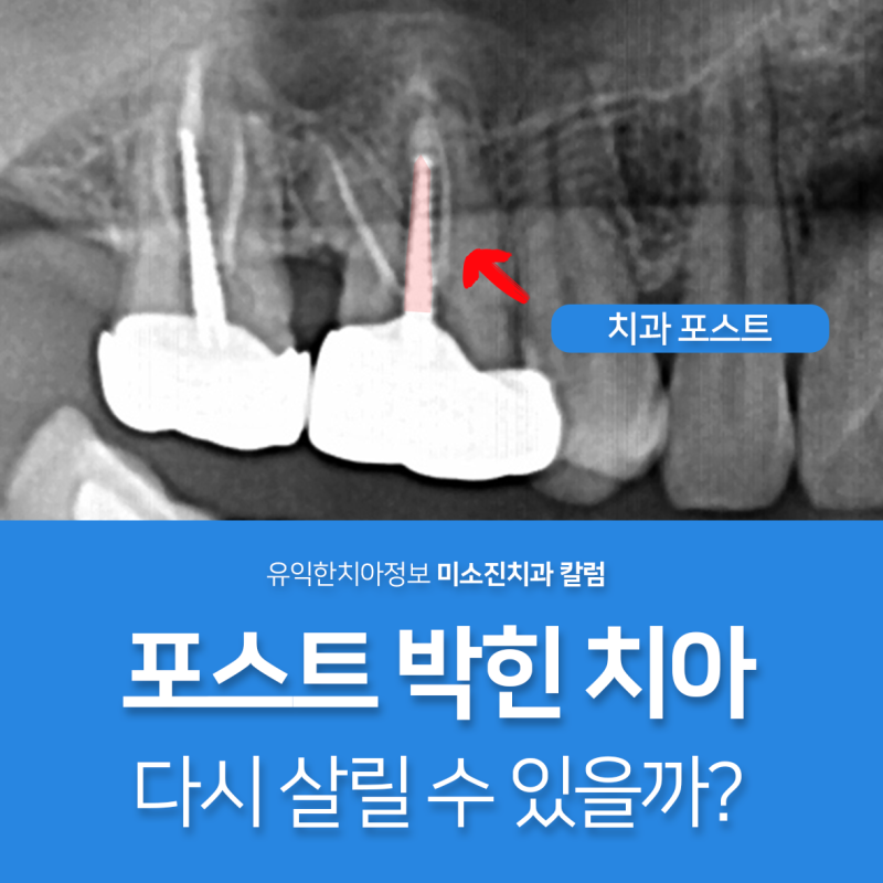 씹을 때 심한 통증 포스트 박힌 치아 가야동치과에서 알려드리는 재신경치료 이야기