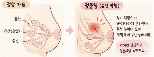 모유수유 젖뭉침 두 번 겪은 후기｜가슴 멍울·열감 증상과 푸는법