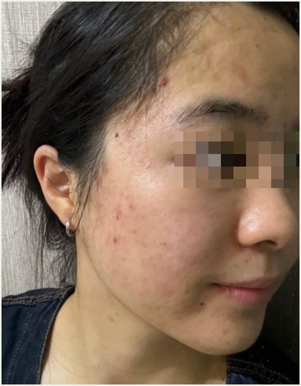 마데카솔겔 두 달 써본 분들?