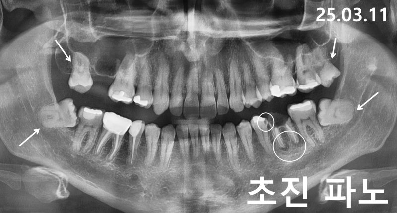 충치 신경치료부터 크라운 브릿지 발치 즉시 임플란트를 통한 비용과 기간을 고려한 복합치....