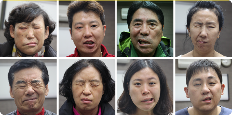 구안와사 후유증치료, 입은 돌아왔는데 웃을 때 어색하다면? 증상별 원인과 관리법