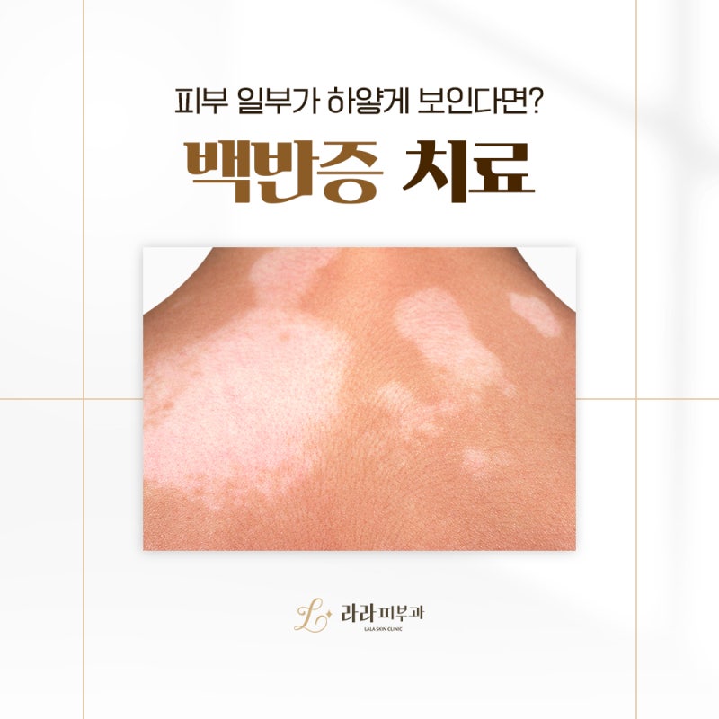 부산백반증 치료 알아보고 있다면 '이것' 먼저 확인해 보세요