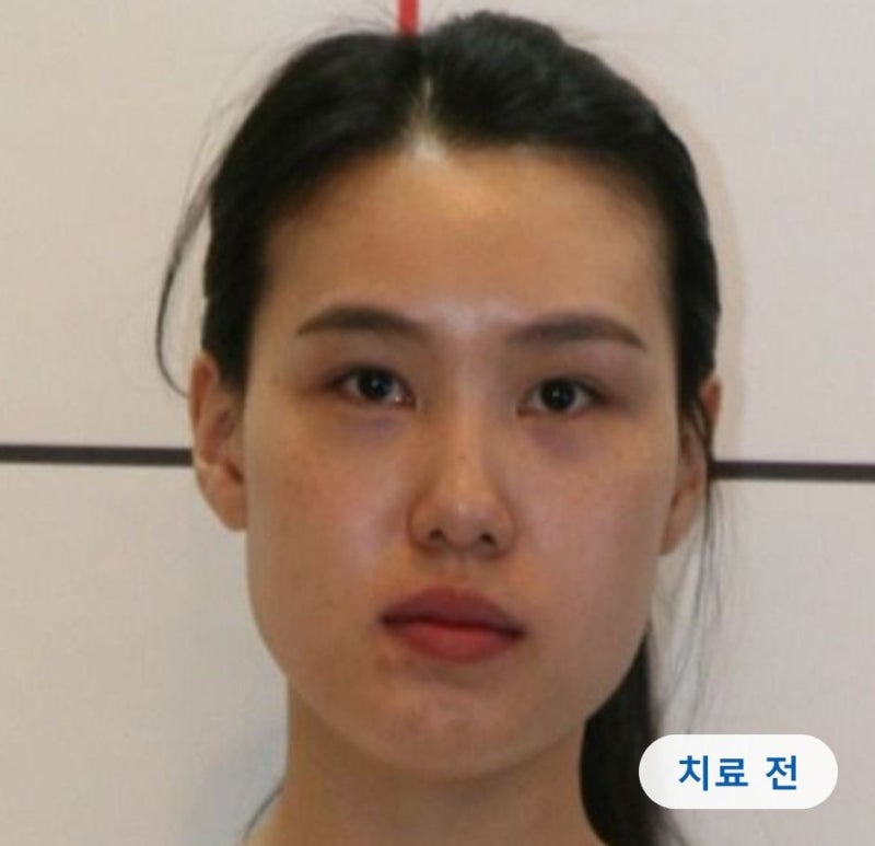 턱관절 통증에 두통까지, 진통제 대신 턱 위치를 바꾼 1년