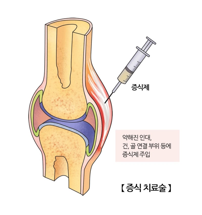 #2.프롤로주사를 맞아도 다시 아팠다::한 달간 100만원 넘게 쓴 치료::25살에 류마티스를 의심....