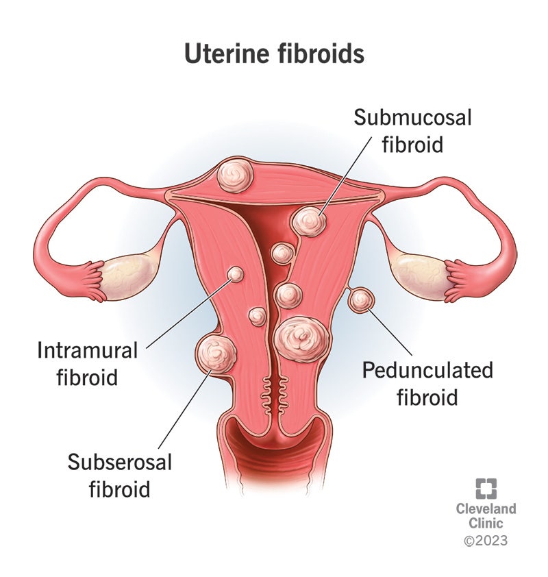 자궁근종의 치료와 관리(Treatment and management of Uterine myoma)