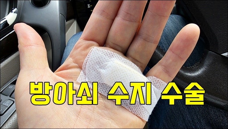 방아쇠수지 수술을 했다