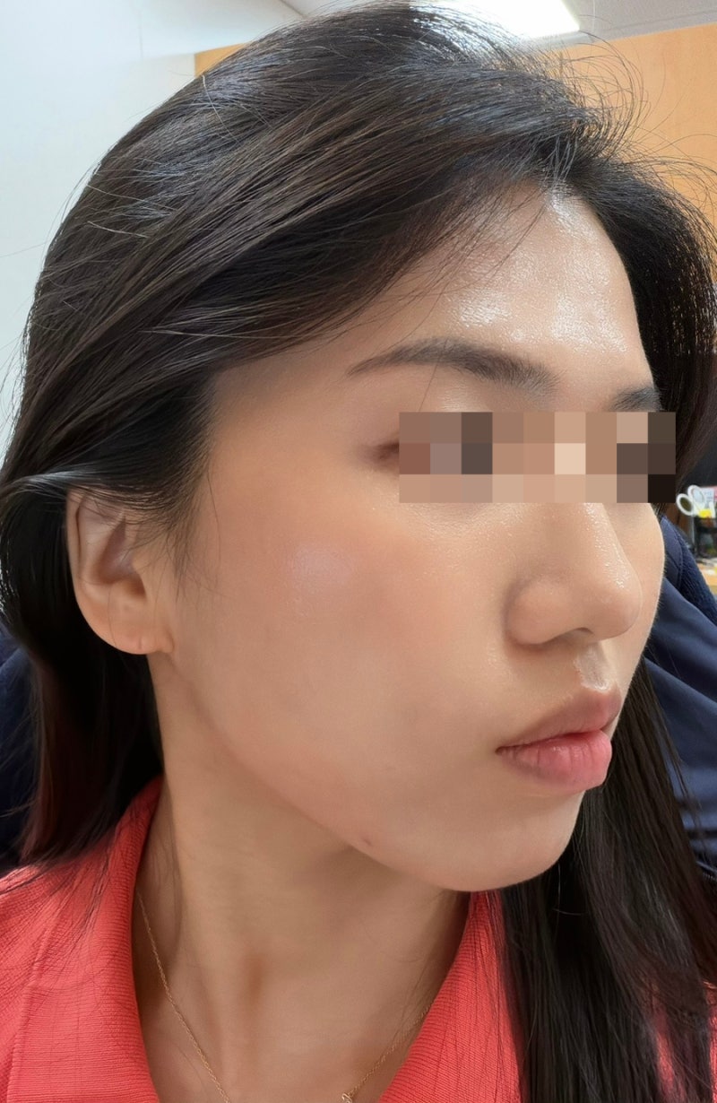 홍대 피부과 모공, 흉터에 좋은 포텐자(비용, 통증, 일상생활)