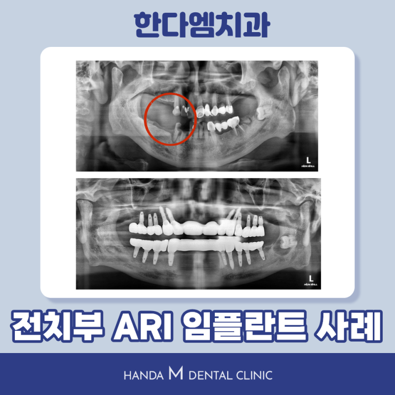 [디오 임플란트 강연] 군포치과, 틀니에서 전악 임플란트로 치료한 사례
