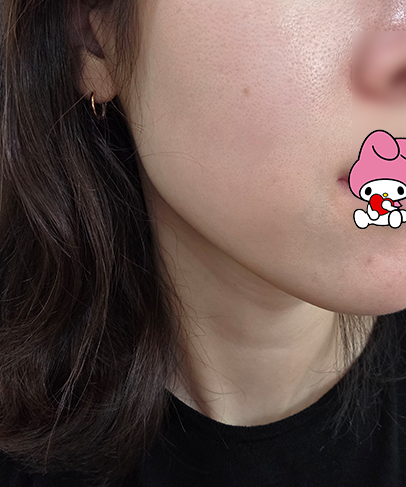 아젤리아크림 주사피부염 사용법& 한달차 후기 (처방, 약국 가격)