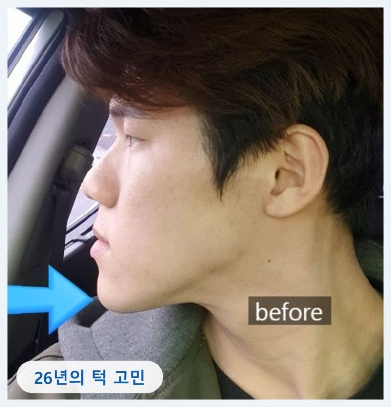 26년 거울을 피하던 주걱턱, 턱교정 6개월 만에 생긴 일