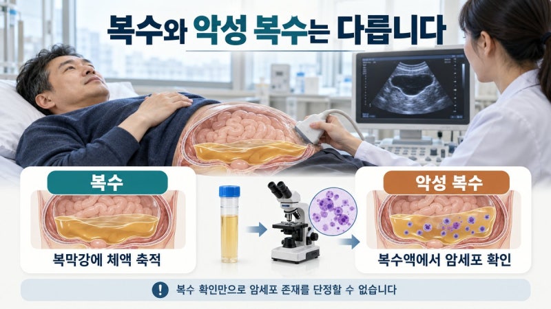 췌장암 복수 차면 4기일까? 원인·증상·복수천자 기준