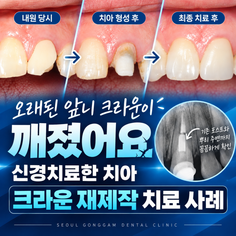 오래된 앞니 크라운이 깨졌어요, 신경치료한 치아 크라운 재제작 사례