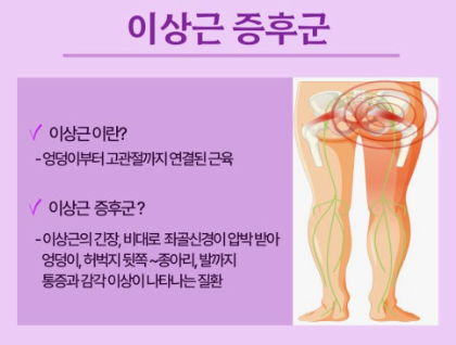 이상근증후군, 엉덩이에서 다리로 저림이 내려온다면
