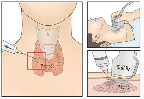 갑상선 세침검사 어떻게 해요? 위험 할까요?