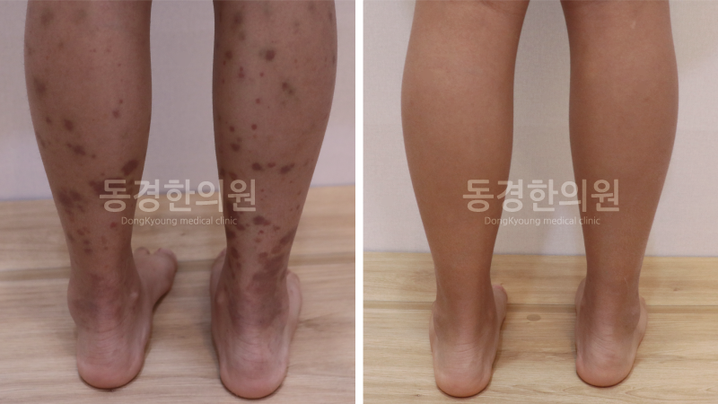 자반증 신장 염증 때문에 걱정이시라면