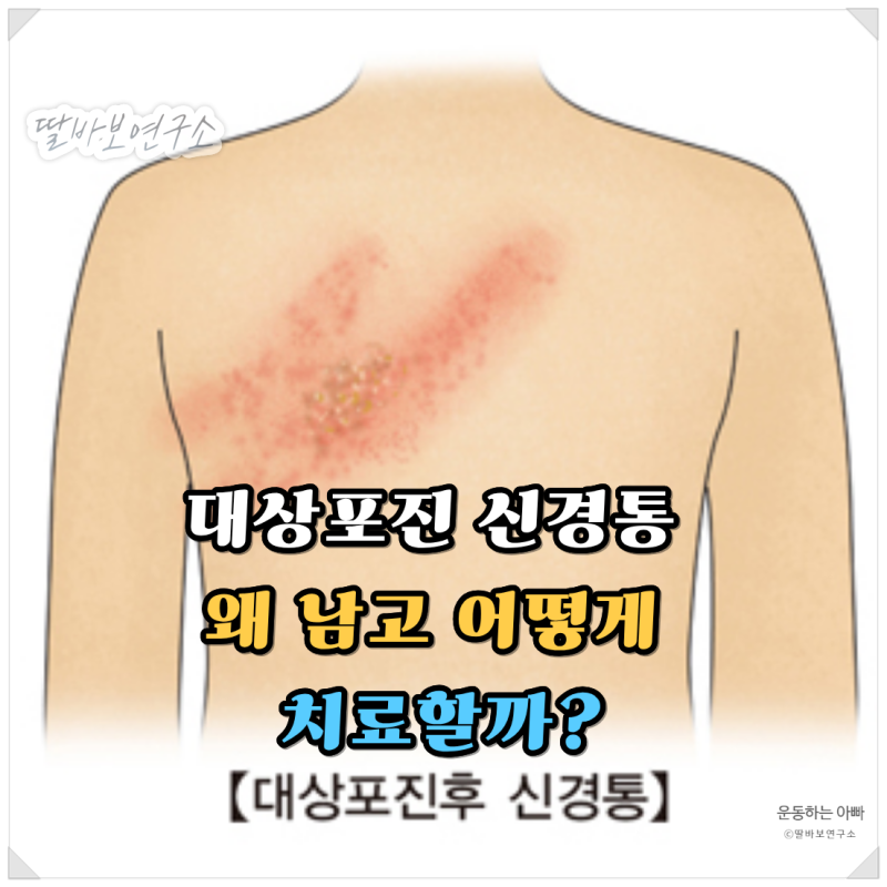 대상포진 신경통 원인과 치료, 피부 수포는 다 나았는데 칼로 찌르듯 아픈 진짜 이유