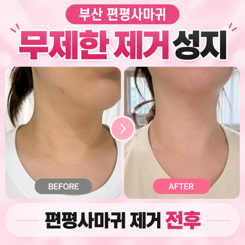 부산 편평사마귀 무제한 제거 성지 직접 다녀온지 2주차 솔직후기