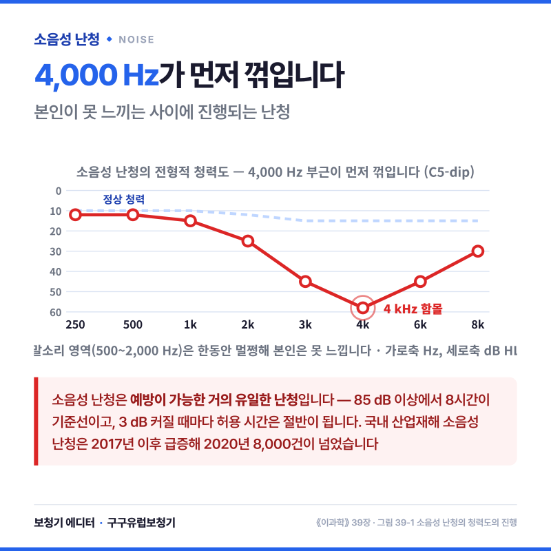 돌발성 난청 · 노인성 난청 · 소음성 난청 · 약물 부작용 난청 · 유전성 난청 — 안 들리는 ....