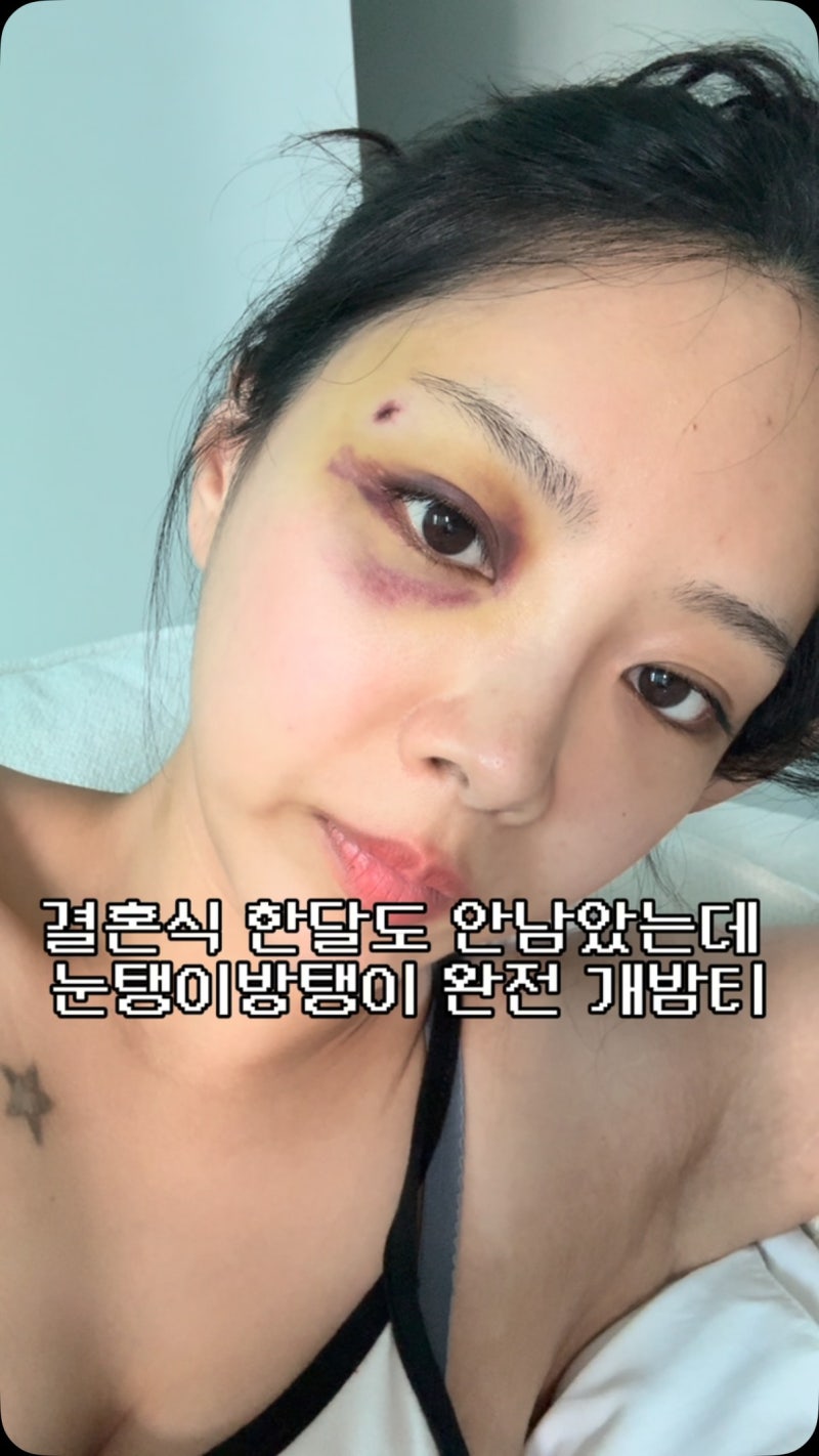 결혼 한 달도 안 남았는데…10기 옥순 김슬기, 눈에 시퍼런 멍 무슨 일?