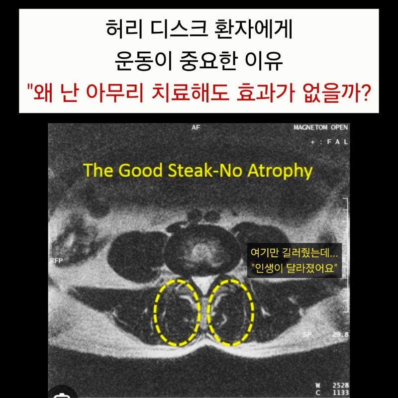 허리 디스크 환자에게 운동이 중요한 이유 "왜 난 아무리 치료해도 효과가 없을까?"