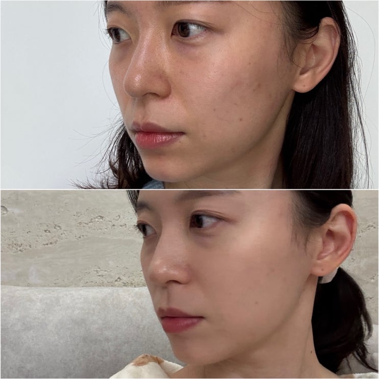 문래피부관리 라온스킨앤바디 페이스관리 윤곽 비포 애프터