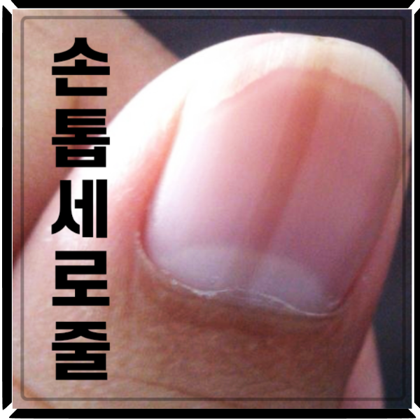  손톱 검은세로줄 발견했다면 꼭 읽어야 할 글