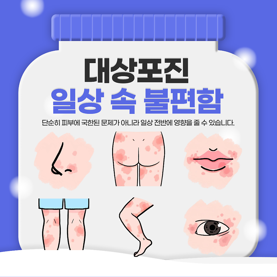 여의도대상포진 원인 증상 초기에 잡야아 합니다